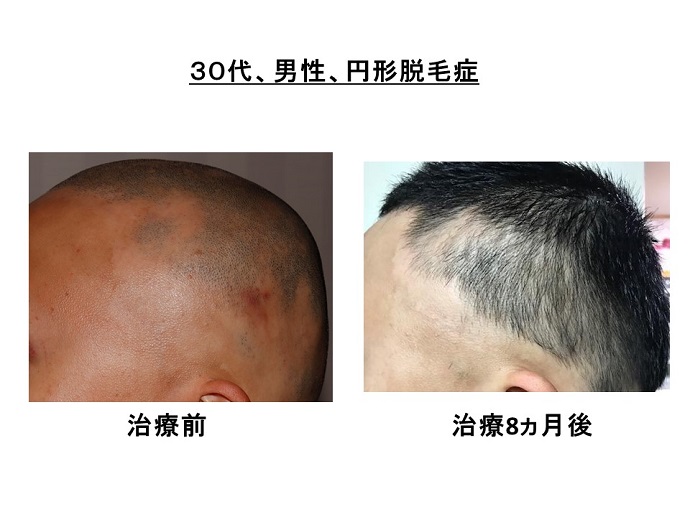 円形脱毛症　病院